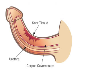 crooked Peyronie's curve image